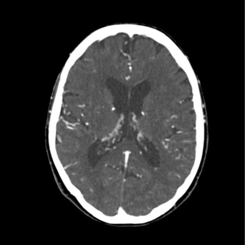 CTA Head Phantom for CT Scan & X-Ray Training - High-Quality Medical Imaging Education Tool for Radiology Students & Technicians