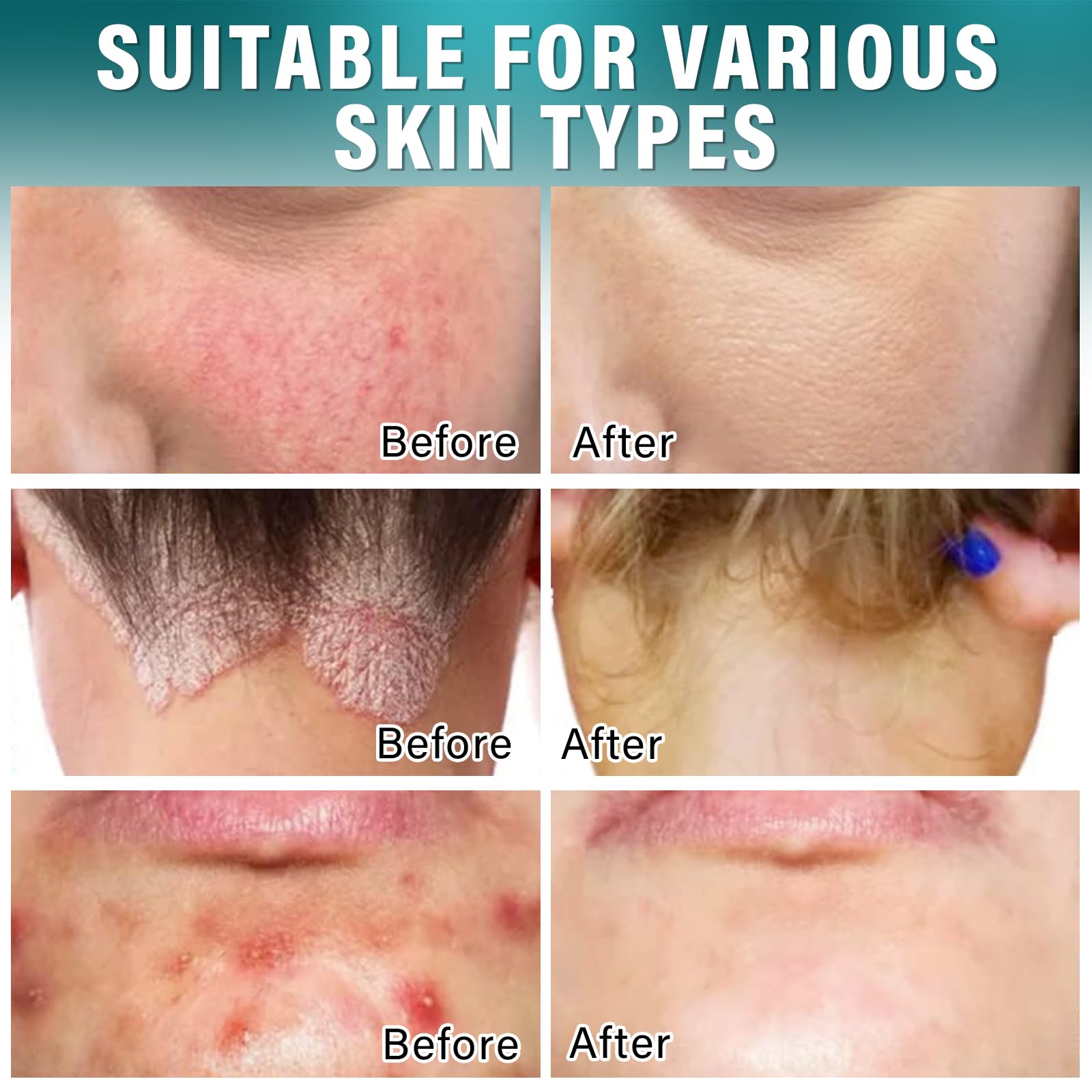 Dijkoo Folliculitis Treatment Cream for Face & Body - Severe & Effective Solution for Men & Women - 60g - Soothes Irritation & Redness for Clear, Healthy Skin - Perfect for Post-Shaving, Acne-Prone Skin & Ingrown Hair Relief