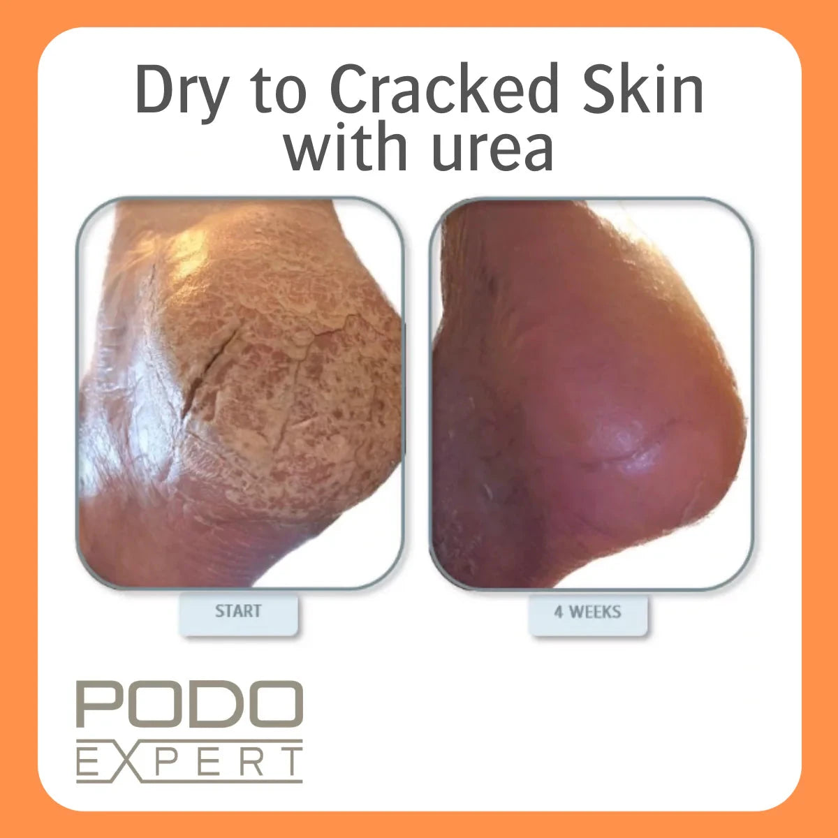 Allpremed Moisturizing Foam for Dry to Cracked Skin - 125ml Hydrating Hand & Foot Care - Perfect for Winter, Eczema & Diabetic Skin Relief