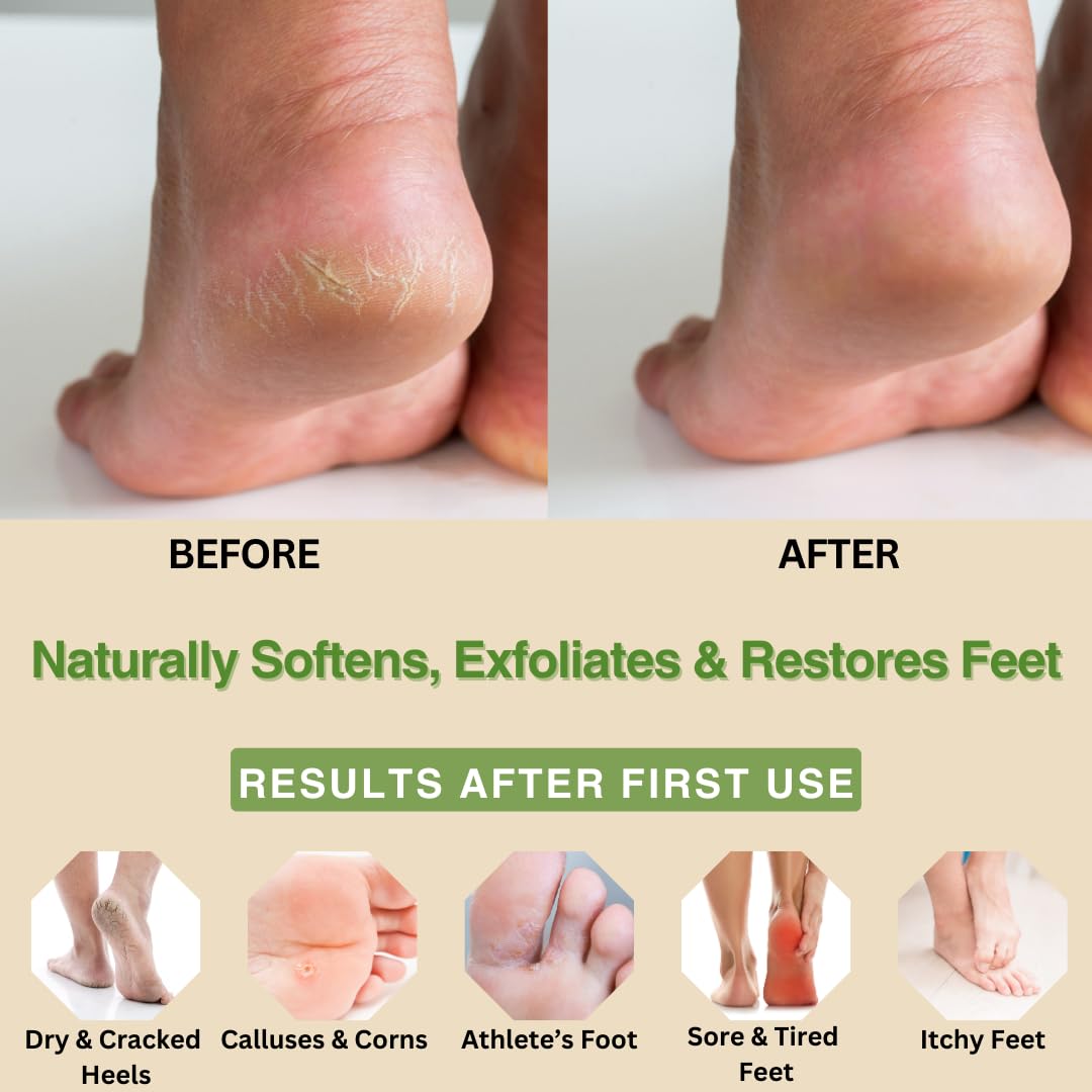 **Peppermint, Rosemary, Eucalyptus & Tea Tree Foot Cream for Dry Cracked Heels – Moisturizing Lotion with Lactic Acid for Callus & Heel Repair (8 oz) – Perfect for Daily Foot Care & Spa Treatments**
