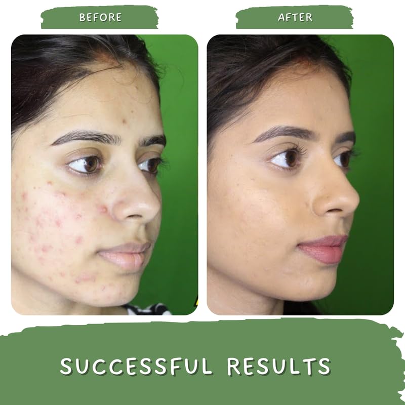 Mystiq Living Green Tea Clarity Gel Cream with 2% Salicylic Acid for Acne Treatment, Pimple & Scar Removal - 50g | Oil-Free Moisturizer for Oily & Acne-Prone Skin | Day & Night Clarifying Gel | Perfect for Daily Skincare Routine & Post-Breakout Recovery