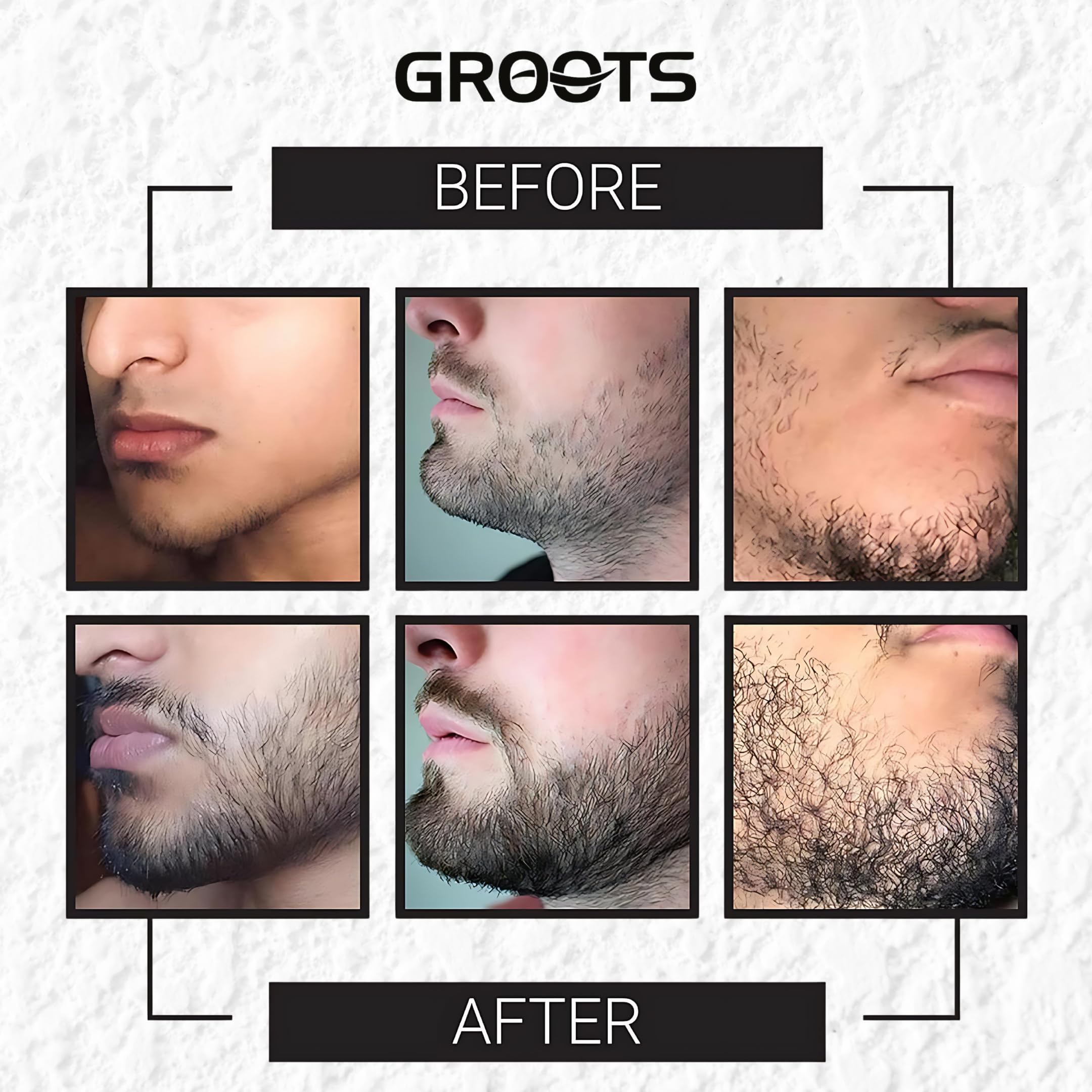 Groots Derma Hair Roller 540 Titanium Alloy Microneedle Roller for Hair Regrowth & Beard Growth | Acne Scar Treatment | Skin Rejuvenation | Hair Follicle Stimulator for Men & Women | Perfect for Home Hair Care & Facial Treatment