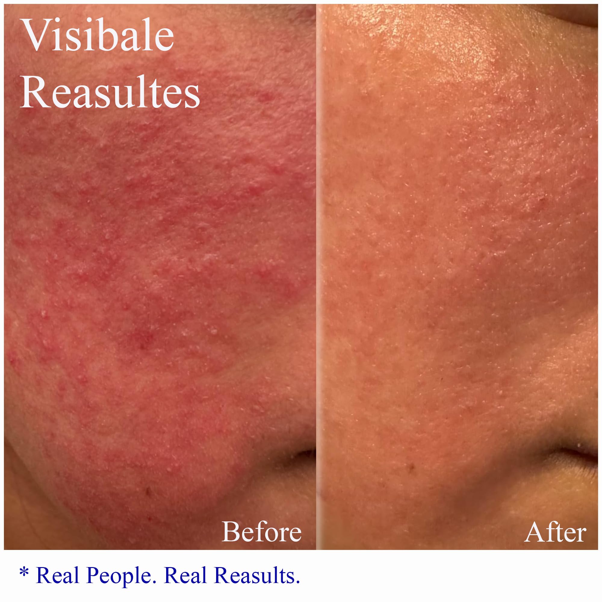 Hey Honey Skincare Relax - Instant Rosacea Treatment & Face Redness Relief | Dermatologist-Tested Calming Moisturizer for Sensitive Skin | Oil-Free with Honey & Propolis | Anti-Aging Benefits | 2.2 Oz | Perfect for Daily Soothing & Redness Reduction