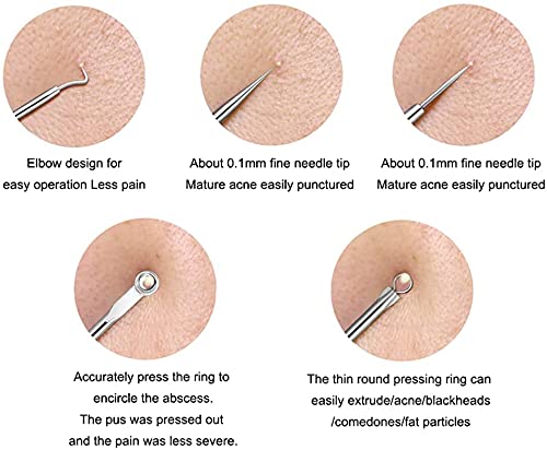 Professional Blackhead Remover Kit - 4-Piece Stainless Steel Comedone Extractor & Acne Needle Tool Set with Storage Case | Perfect for Facial Cleansing, Pore Treatment & At-Home Skincare Routine