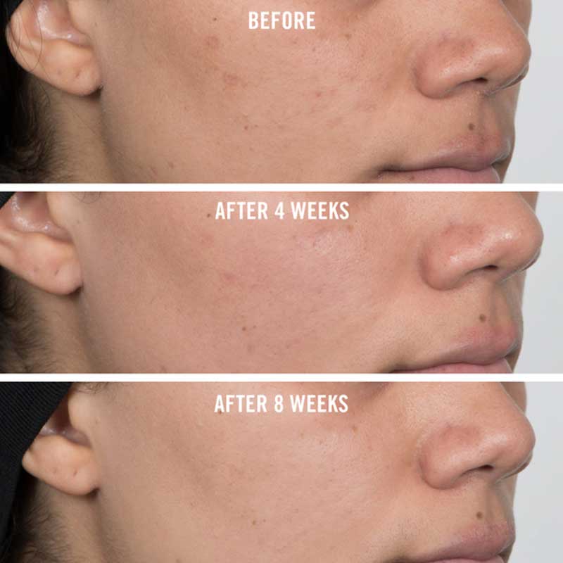 First Aid Beauty Facial Radiance Niacinamide Dark Spot Serum - Brightening Serum for Hyperpigmentation & Uneven Skin Tone - Perfect for Daily Skincare Routine & Nighttime Treatment