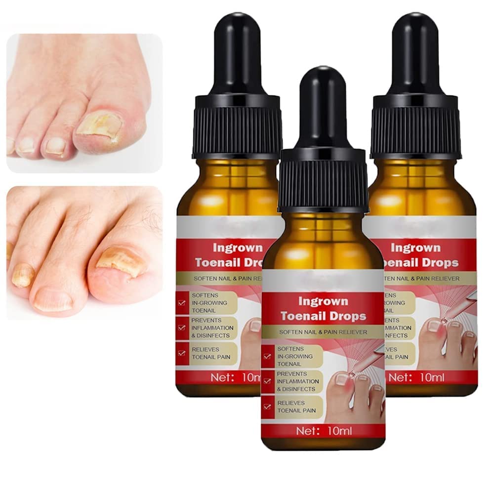 Ingrown Toenail Correction Oil & Fungal Treatment Drops - 3 Pack for Pain Relief & Nail Care | Home Pedicure Solution for Ingrown Toenails & Nail Fungus
