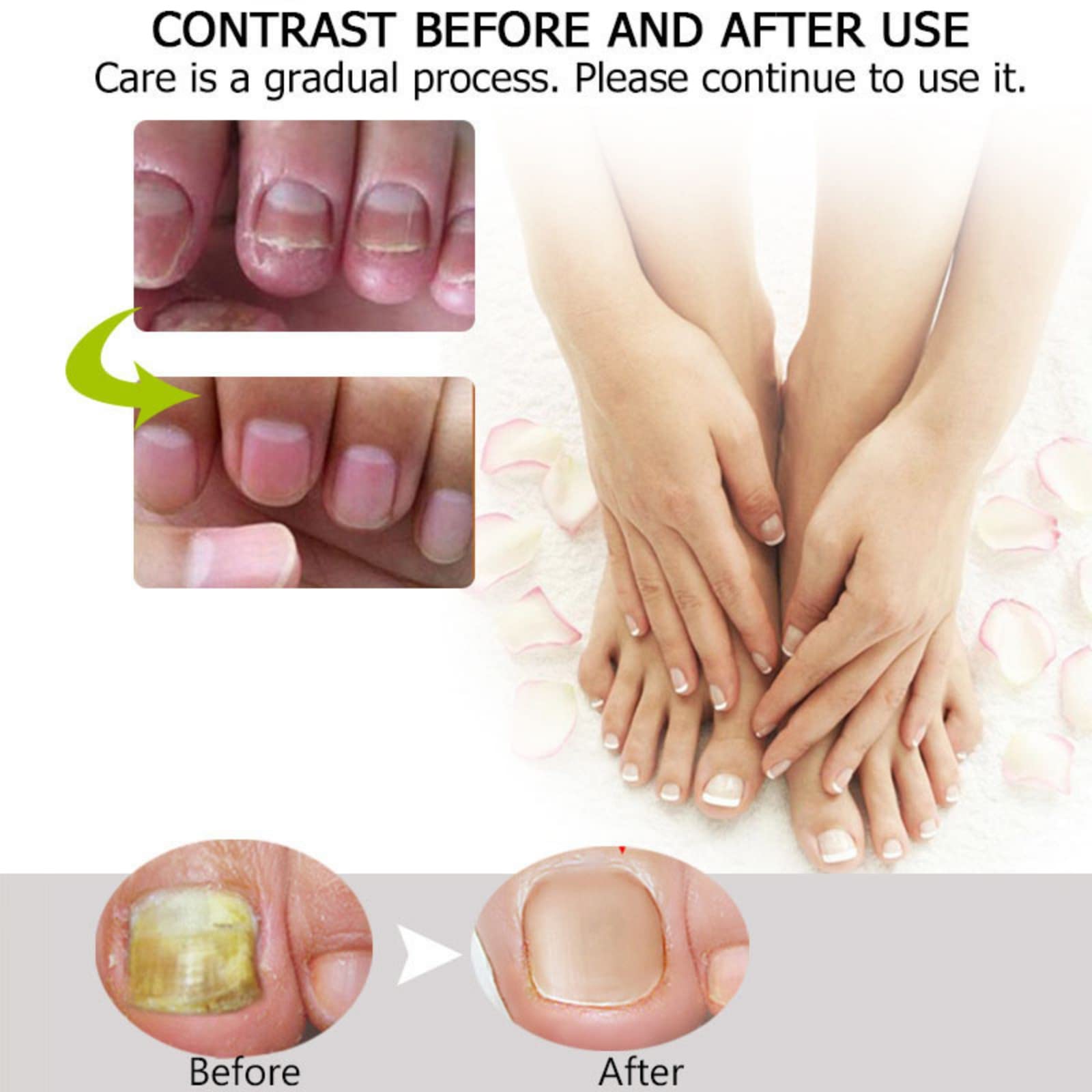 2PCS Nail Repair Gel for Fungal & Damaged Nails - Toenail Treatment & Care - Fast Results in 7 Days - Strengthens & Restores Nails - Perfect for Pedicures, Manicures & At-Home Nail Care