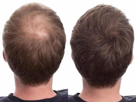 AOQ Hair Building Fibers for Thinning Hair - Natural Black Hair Loss Concealer & Instant Volume Styling Powder (28g) - Perfect for Men & Women with Bald Spots, Receding Hairlines & Thinning Hair for Everyday Confidence