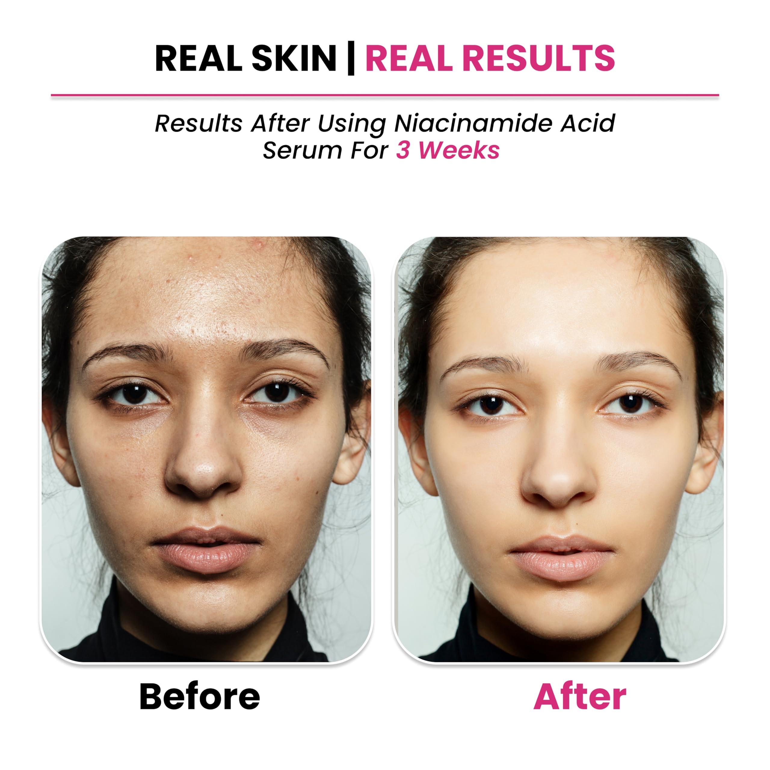 THRIVECO 10% Niacinamide Face Serum with 1% Zinc PCA - Brightening Acne Treatment for Clear, Glowing Skin - 30ml Anti-Blemish Solution for Men & Women - Perfect for Daily Skincare Routine & Acne-Prone Skin Care