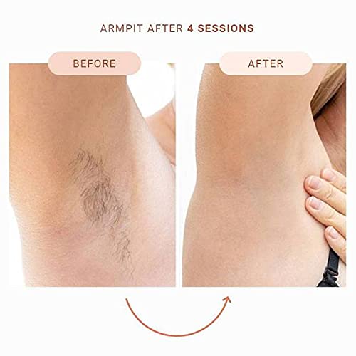 Skinna IPL Laser Hair Removal System for Women & Men - Permanent Painless At-Home Hair Remover for Face, Arms, Legs, Bikini Line & Full Body | Safe & Effective DIY Laser Hair Removal Device | Perfect for Smooth Skin Before Beach Vacations, Date Nights & Summer Outfits