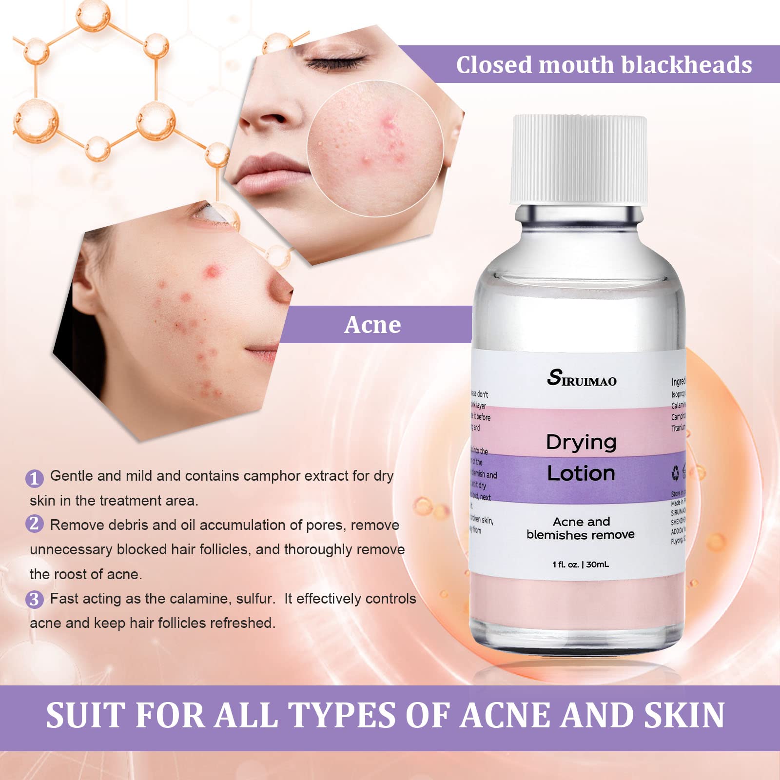 Stubborn Acne Drying Lotion (1OZ) - Overnight Acne Spot Treatment with Salicylic Acid for Face & Body | Fast-Acting Pimple Lotion to Dry Out Blemishes, Zits & Unclog Pores | Perfect for Teen & Adult Acne Care, Travel-Friendly Skincare Solution