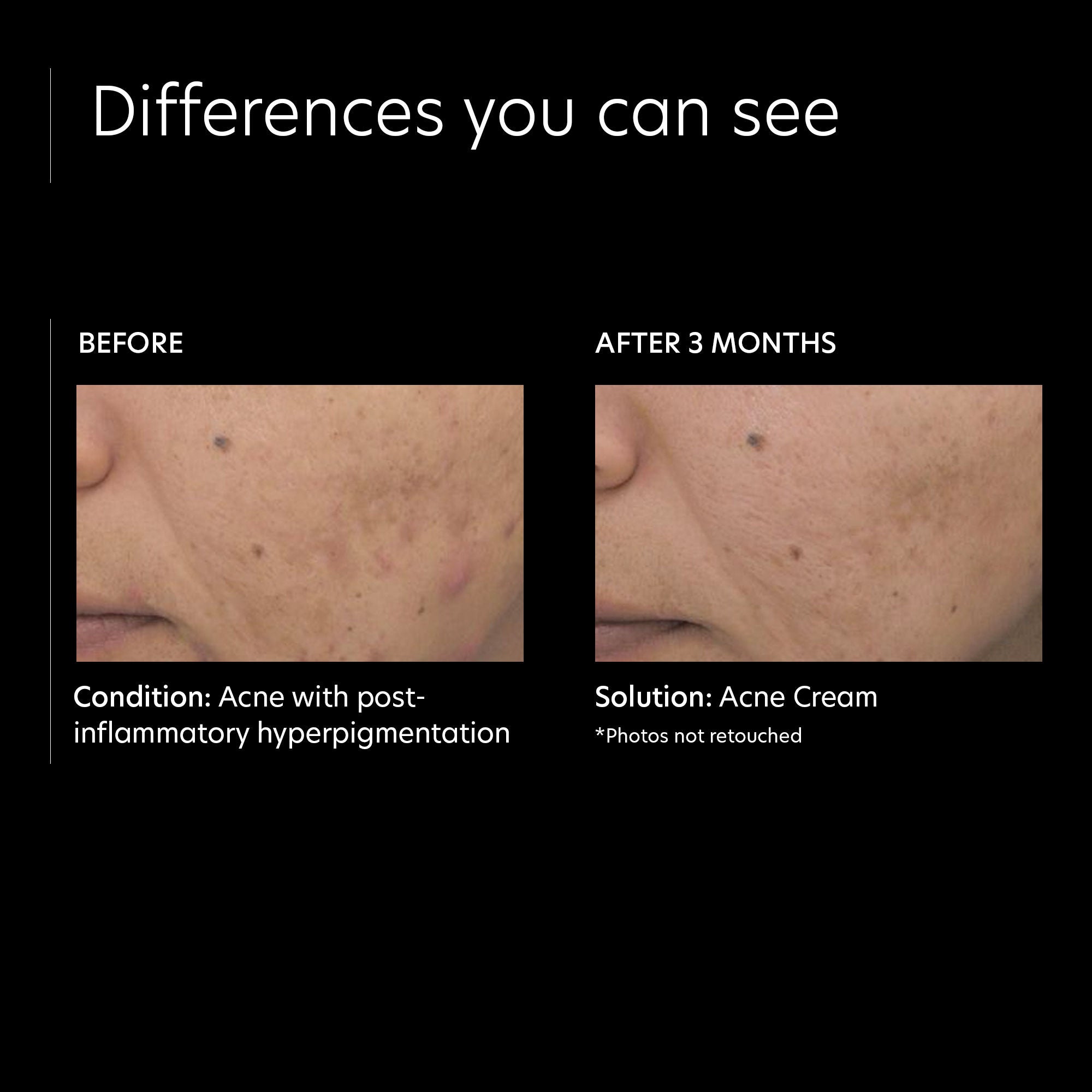 PCA Skin Acne Treatment Cream - Professional Strength Acne Spot Treatment for Face & Body - Clear Breakouts Fast - Perfect for Daily Skincare Routine & Travel