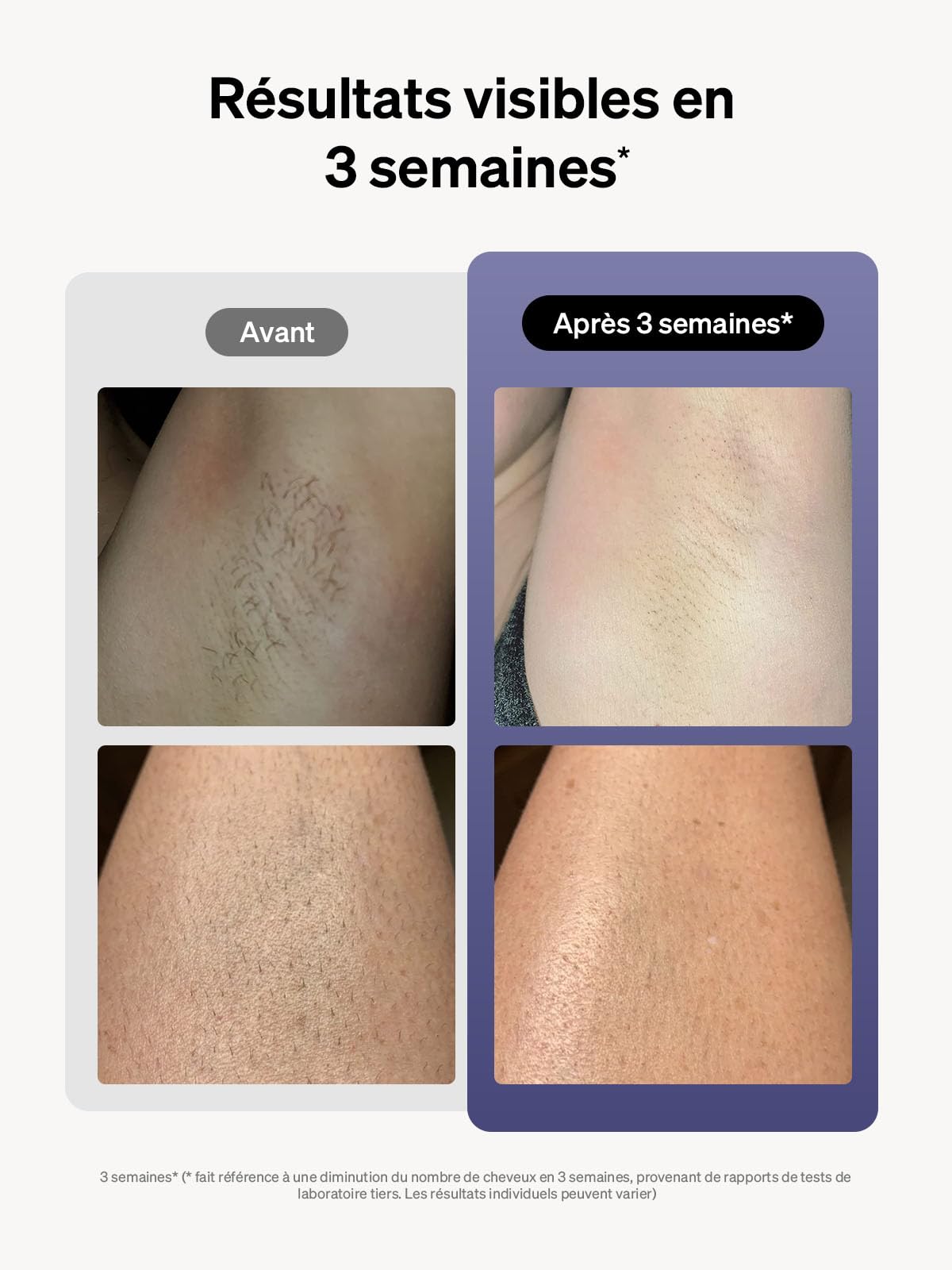 Ulike Air 3 IPL Laser Hair Removal Device for Women & Men - Sapphire Ice Cooling System for Painless At-Home Treatment - Permanent Hair Reduction for Face, Legs, Arms & Bikini Line | Perfect for Smooth Skin Before Beach Vacation or Special Occasions