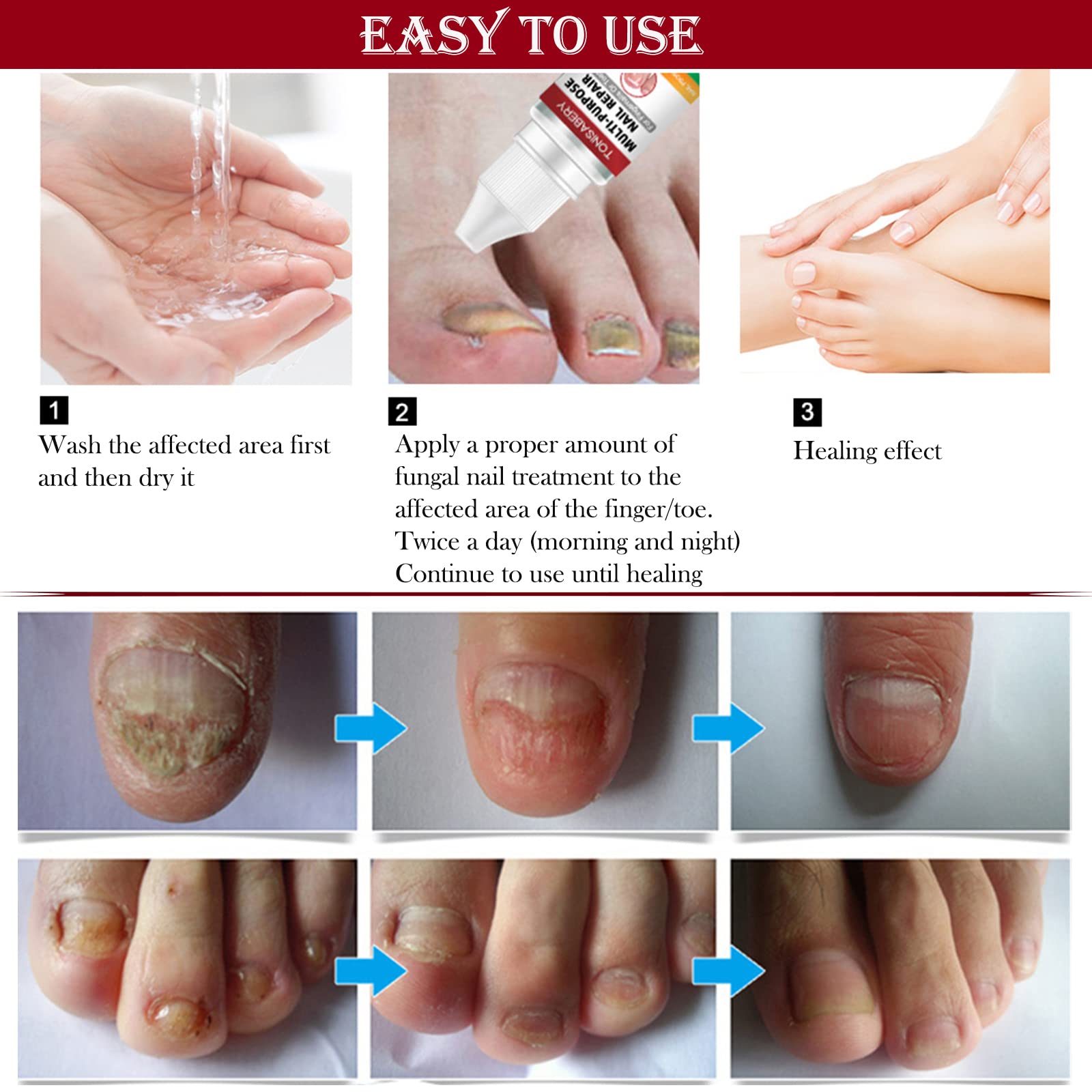 Extra Strong Fungal Nail Treatment for Toenails & Fingernails | Safe & Effective Nail Repair Lotion | Fixes Discolored & Damaged Nails | Multi-Purpose Antifungal Solution (10ML, Red) | Perfect for Athletes, Swimmers & Daily Foot Care