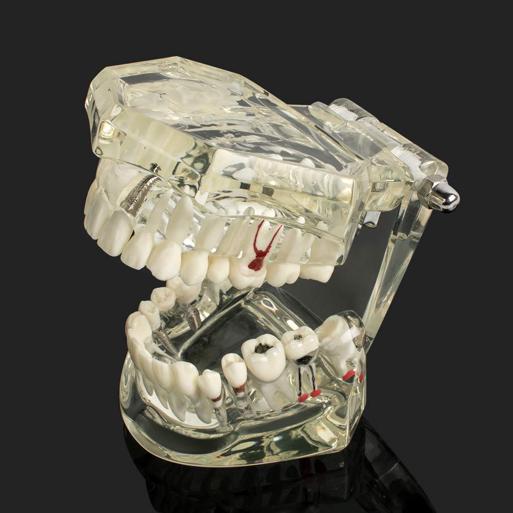 Dental Teeth Model - Transparent Implant Disease Removable Tooth Demonstration Kit for Dental Students & Professionals | Perfect for Classroom Teaching, Clinical Training & Patient Education