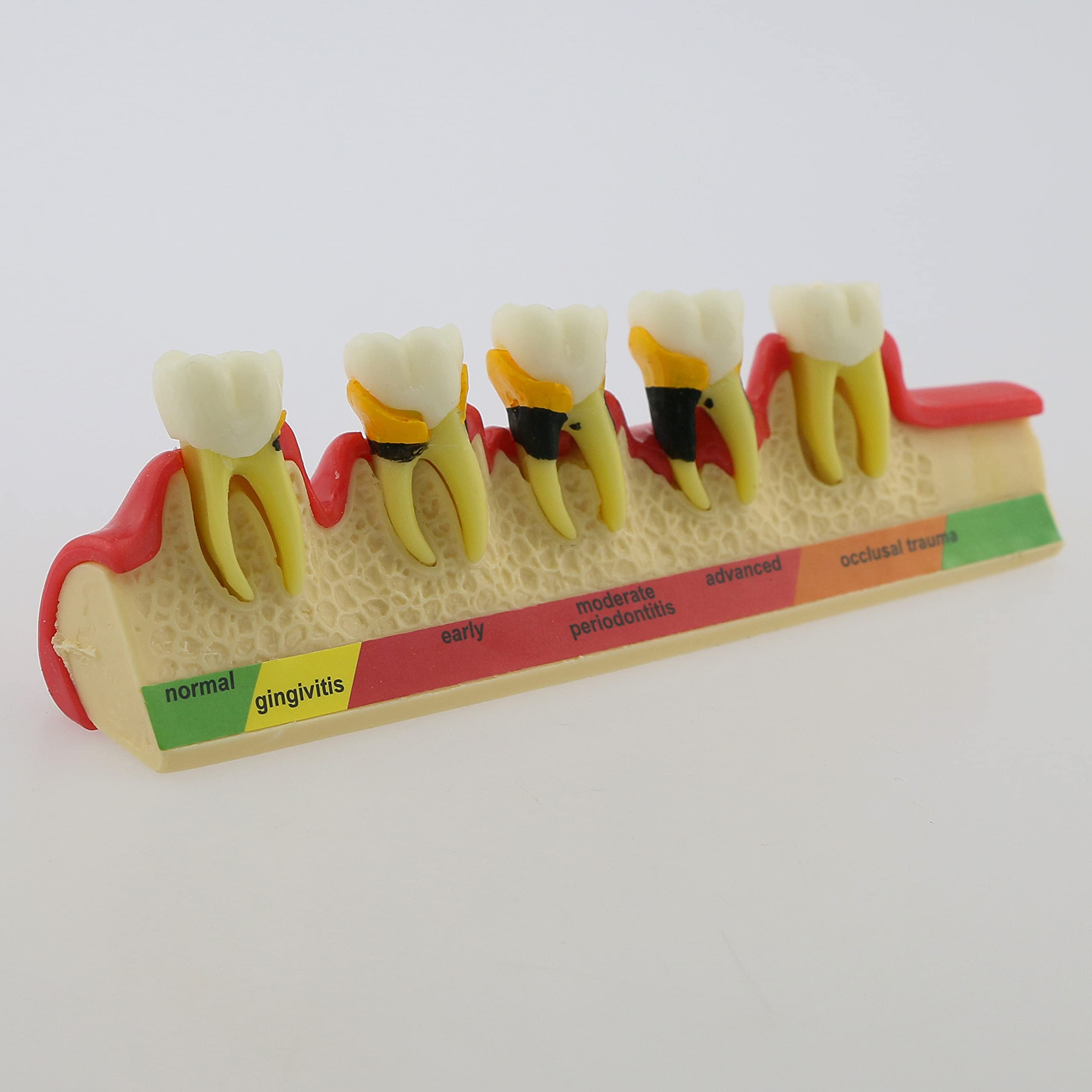 Dental Typodont Teeth Model for Adults & Children - Pathological Demonstration for Teaching & Studying (M4010) | Ideal for Dental Schools, Training & Clinical Practice