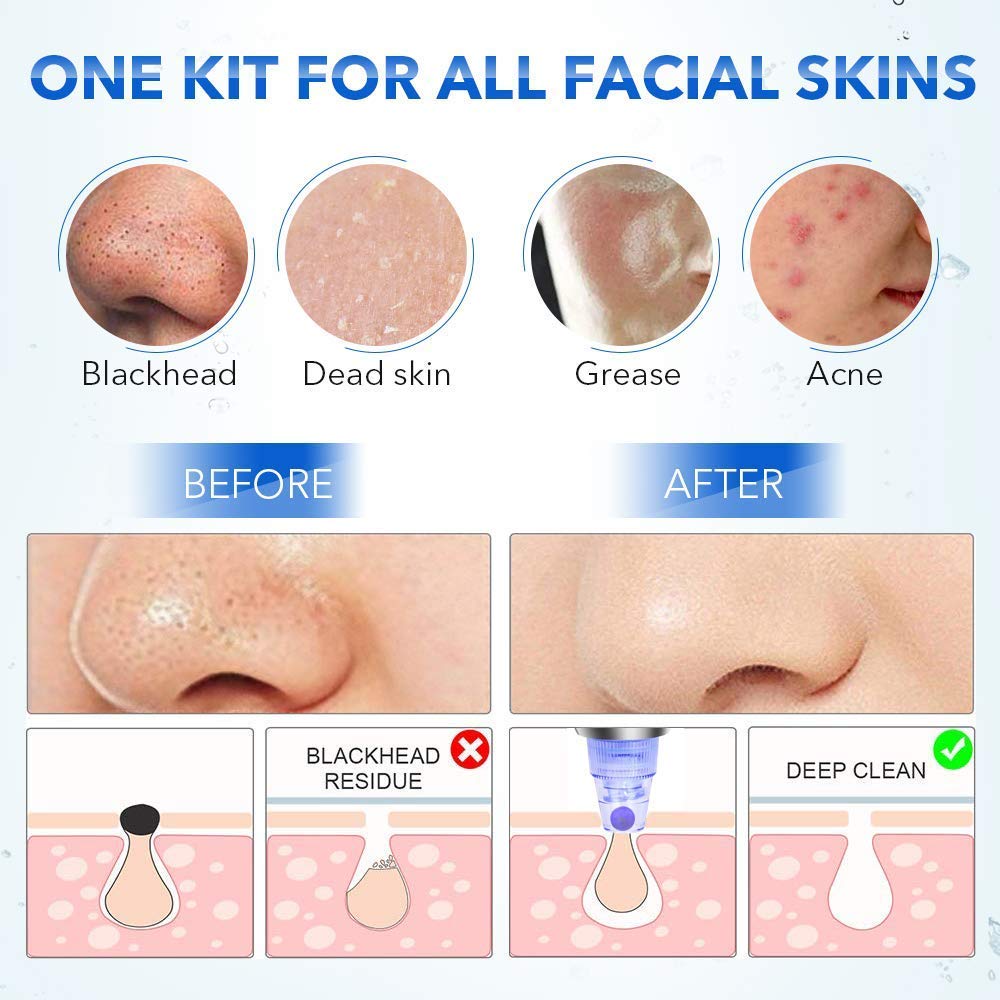 WAZDORF Professional Acne Pore Cleaner & Blackhead Remover Vacuum Kit - Facial Skin Care Tool for Pimple Treatment & Deep Cleansing - Perfect for Daily Skincare Routine & Spa Day at Home (Blue)