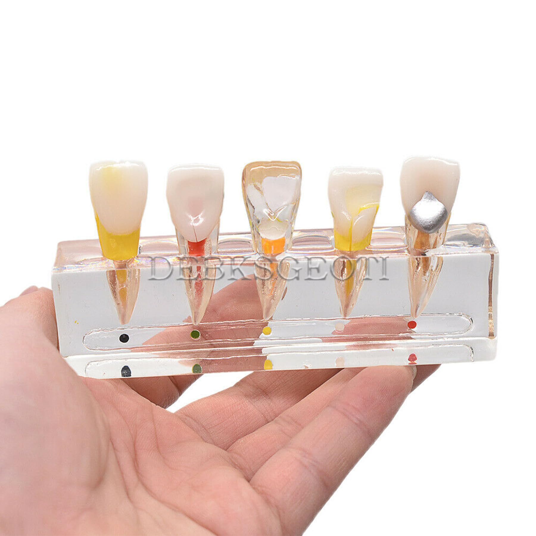Dental Typodont Model for Caries Treatment - M4008 Anatomical Demonstration Kit for Incisor & Diseased Teeth | Dental Education, Student Practice & Clinical Training