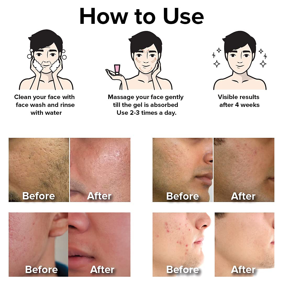 GHC AHA-BHA Face Gel for Acne Treatment - Fights Active Acne & Blemishes, Brightens Skin Tone, 30g - Perfect for Daily Skincare Routine & Oily/Acne-Prone Skin