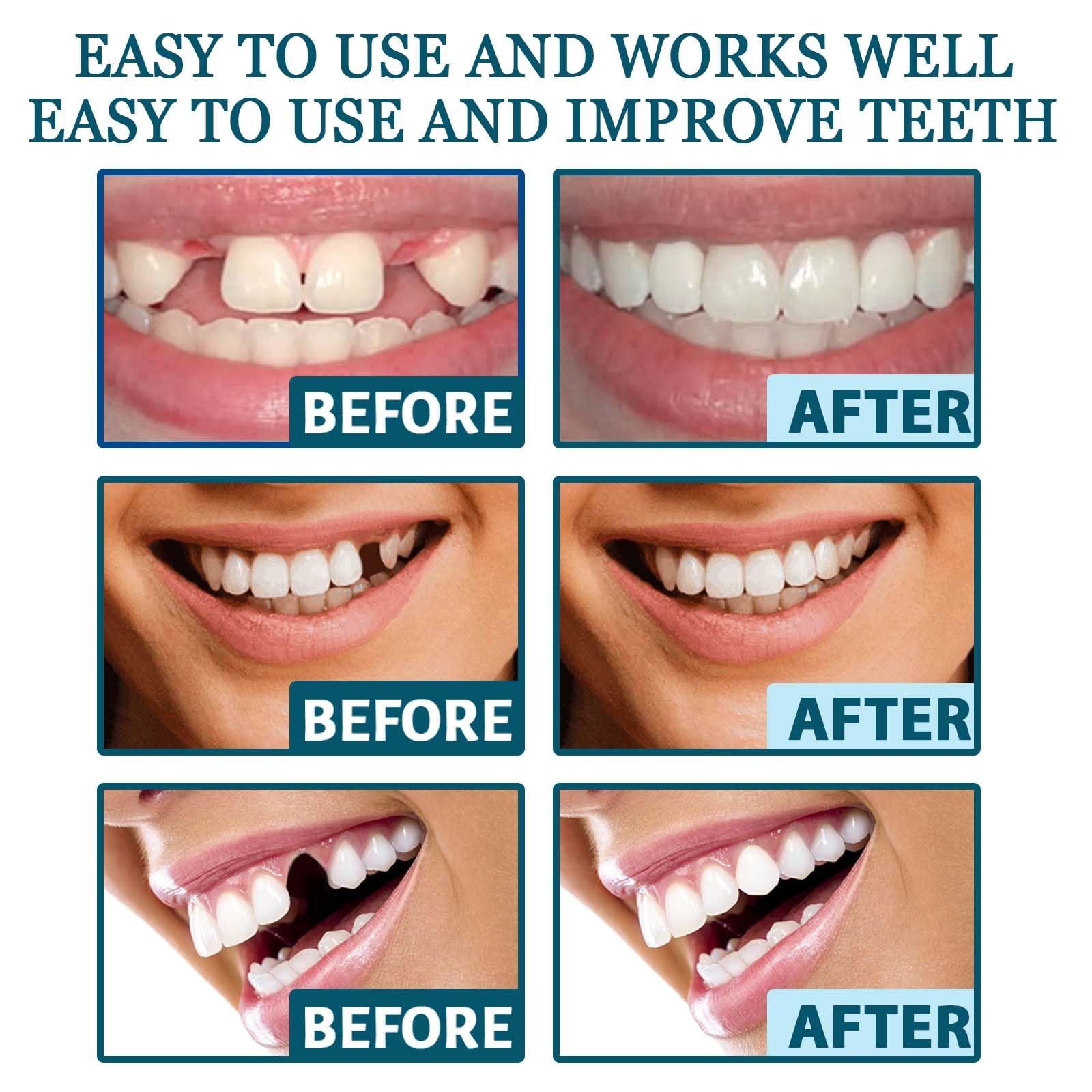 Adjustable Snap-on Dentures Kit - Temporary Teeth Repair & Denture Alignment Solution for Missing Teeth | Perfect for Emergency Dental Care, Travel & Daily Use