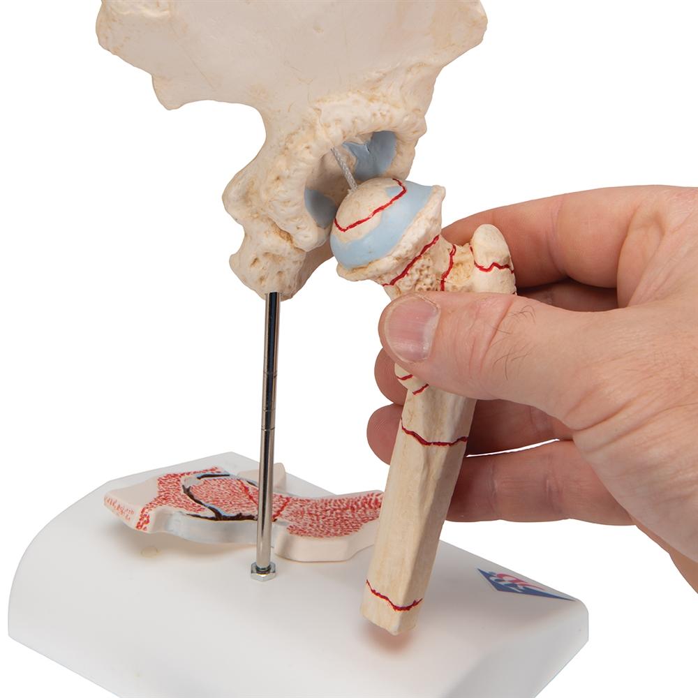 Femoral Fracture & Hip Osteoarthritis Anatomical Model - Medical Training, Student Education, and Clinical Demonstration Tool