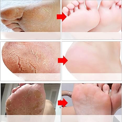 ADBHUTANAND Natural Foot Peeling Mask - Exfoliating Treatment for Dry Skin, Callus & Cracked Heels | Dead Skin Removal | Baby Soft Smooth Feet | 1 Count | Perfect for Pedicures & At-Home Foot Care