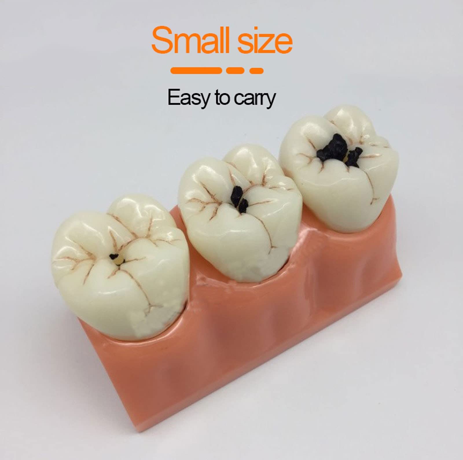 **Removable Dental Teeth Model - Caries & Tooth Decay Demonstration Kit for Dental Education, Teaching & Oral Health Training - Perfect for Dentists, Students & Classroom Learning**    *(Ideal for dental schools, clinics, patient education & hands-on training!)*