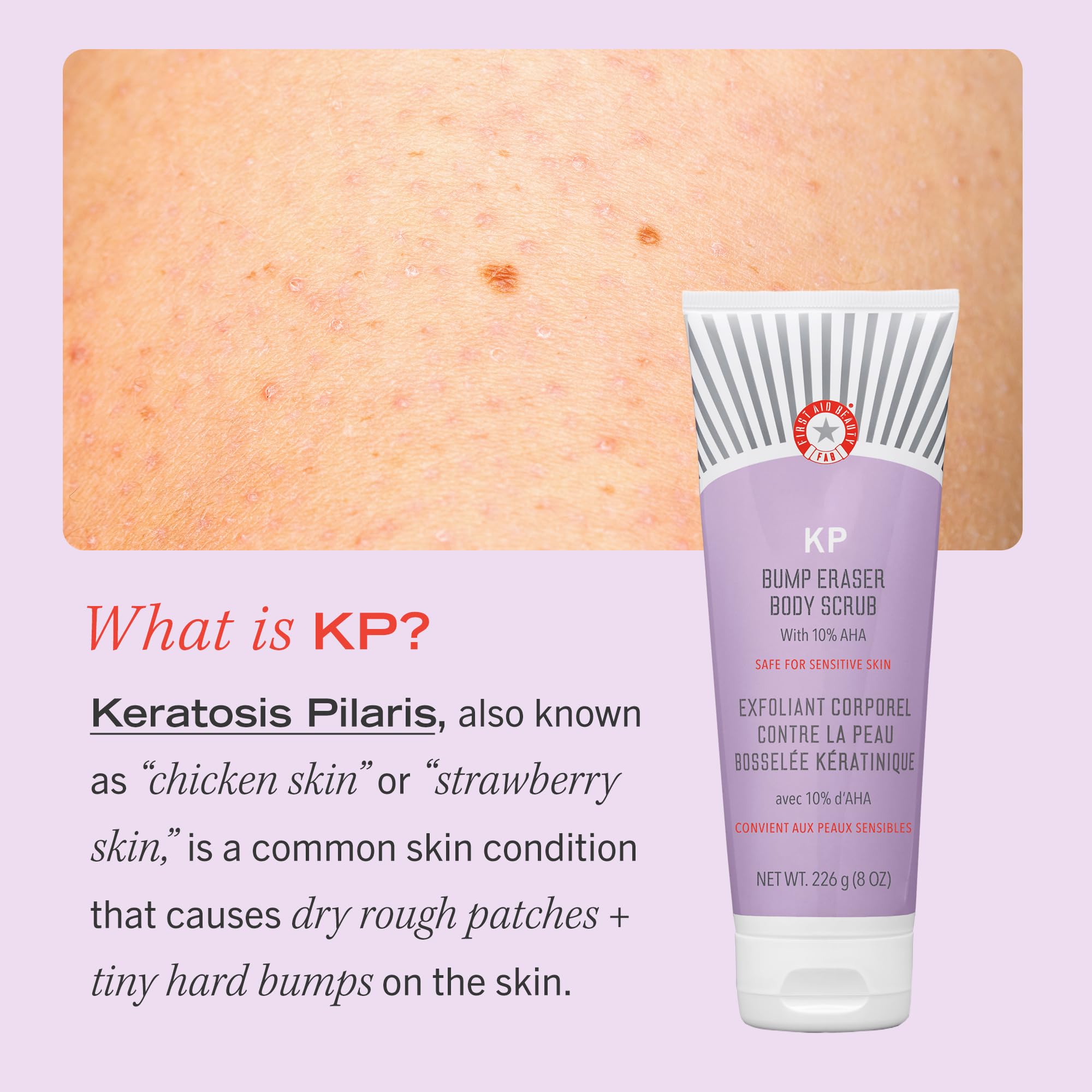 First Aid Beauty KP Bump Eraser Body Scrub - 10% AHA Exfoliator for Keratosis Pilaris with Glycolic & Lactic Acids - Reduces Chicken Skin Bumps - Gentle for Sensitive Skin - 10 oz - Perfect for Dry, Rough Skin Care & Body Smoothing Routine