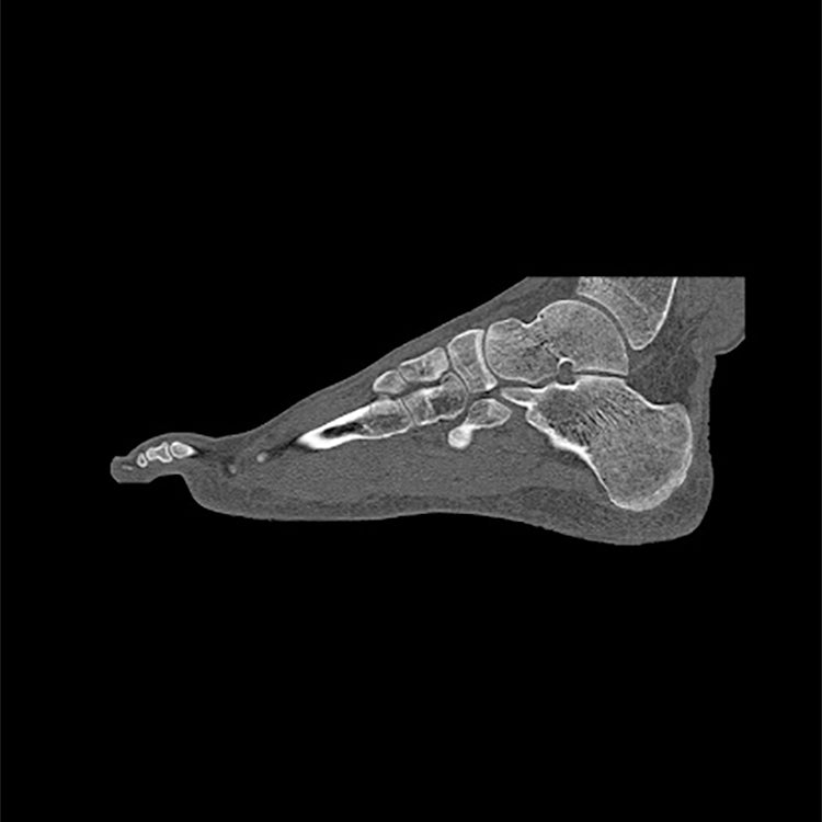 Foot Phantom Metatarsal Fractures Model - Realistic CT Scan & X-Ray Training Tool for Medical Students & Radiologists - Perfect for Anatomy Study & Diagnostic Practice