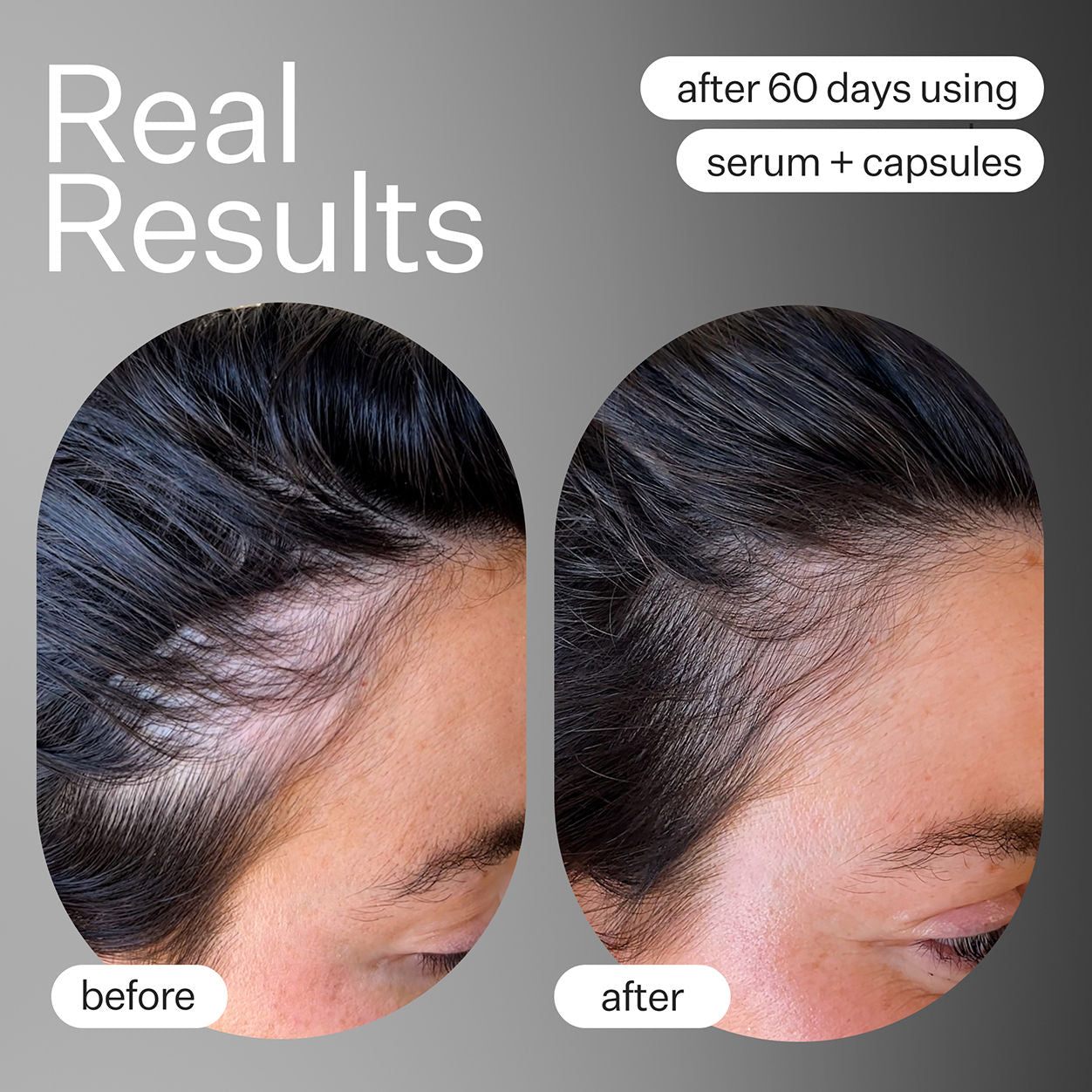 Advanced Fuller Hair System for Men & Women - Natural Looking Hair Thickening Solution for Daily Use & Special Occasions
