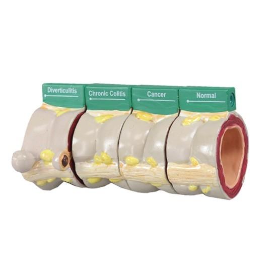 4-Piece Colon Anatomy Model with Pathologies - Ideal for Medical Students, Doctors & Healthcare Professionals