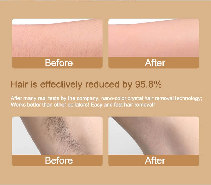 Painless & Safe Epilator for Hair Removal – Easy to Clean & Use at Home | Perfect for Legs, Underarms & Bikini Line