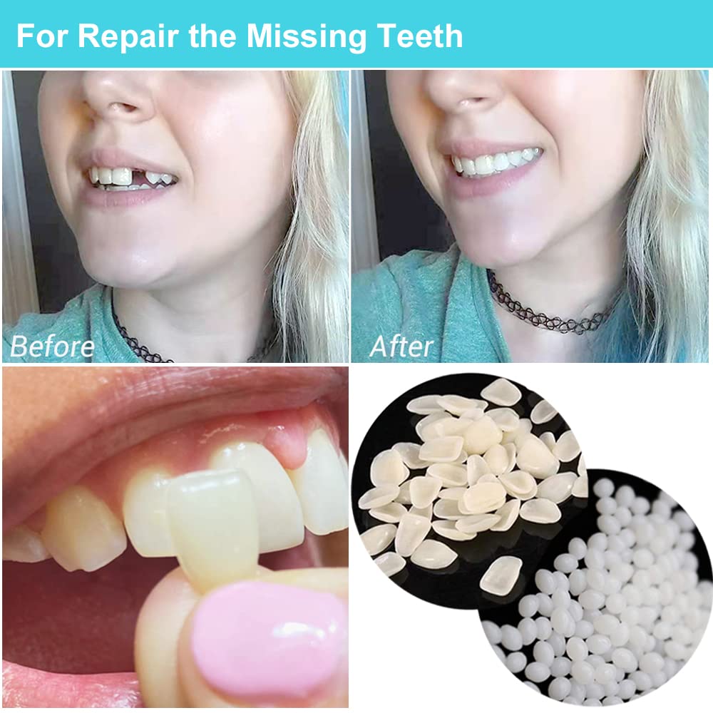 Dental Repair Kit for Missing & Broken Teeth - Moldable Fake Teeth & Thermal Beads Replacement - Perfect for Emergency Tooth Filling & Gap Repair at Home, Travel, or Outdoor Activities