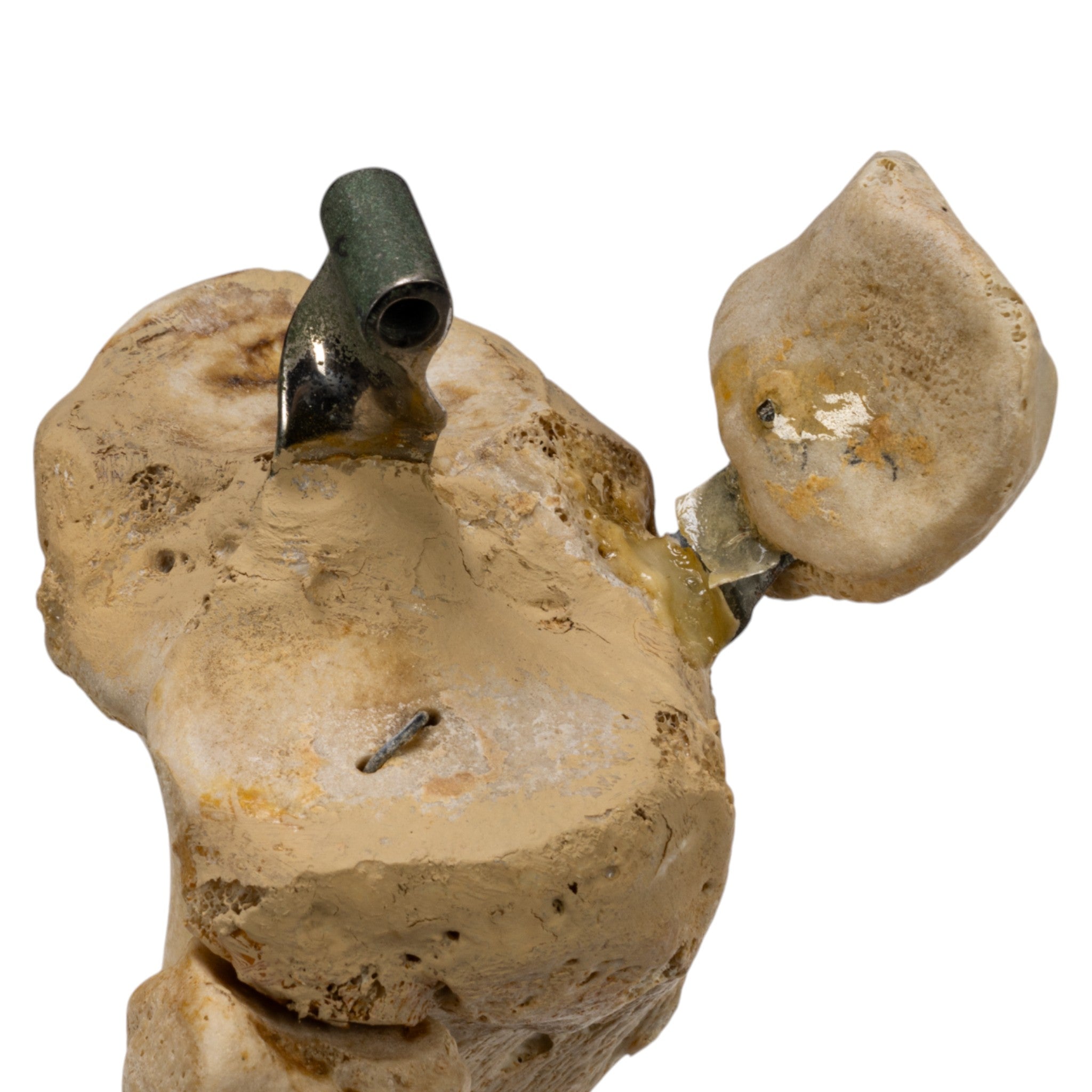 Realistic Human Right Leg Prosthetic - Partial & Articulated for Medical Training, Amputee Rehabilitation & Anatomy Study