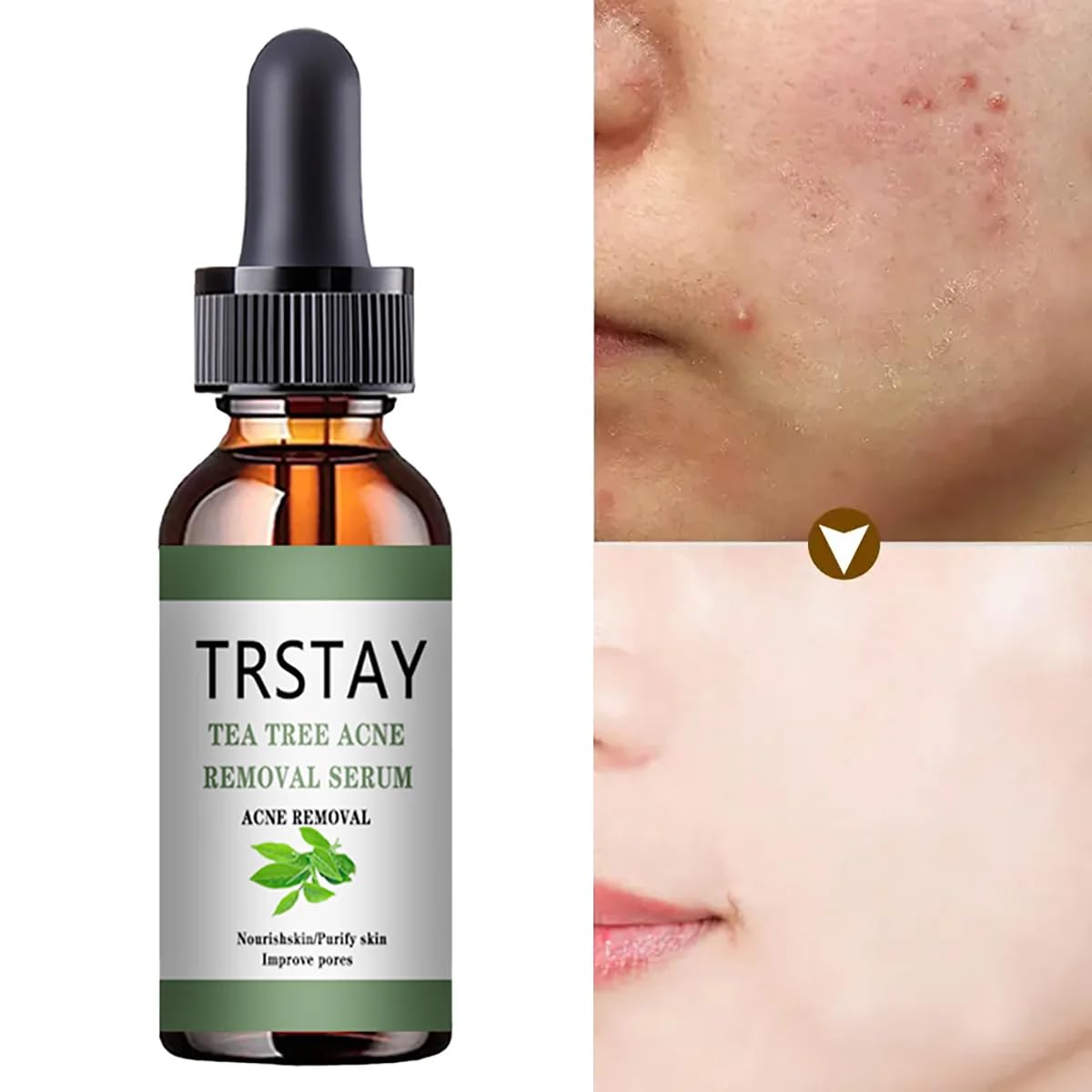 Tea Tree Oil Acne Treatment Face Serum - Korean Skin Care for Moisturizing, Pore Minimizing & Acne Relief | Perfect for Oily, Acne-Prone Skin & Daily Skincare Routine