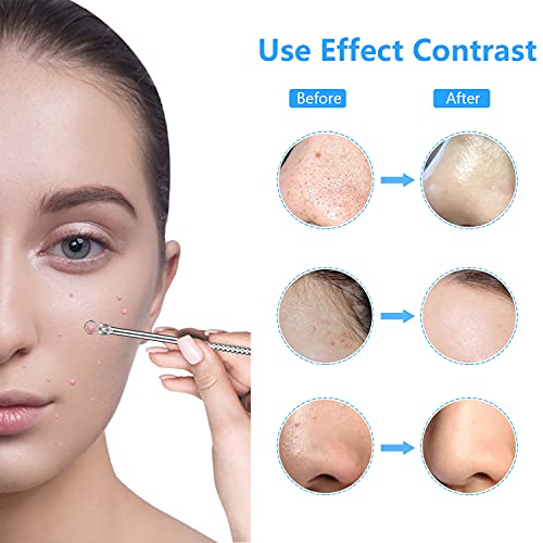 2024 Professional Blackhead Remover Kit - 20PCS Stainless Steel Comedone Extractor Tools for Acne, Pimples & Whitehead Removal - Dermatologist-Recommended Blackhead Extractor Set for Face & Body Care - Perfect for Home Spa & Skincare Routine