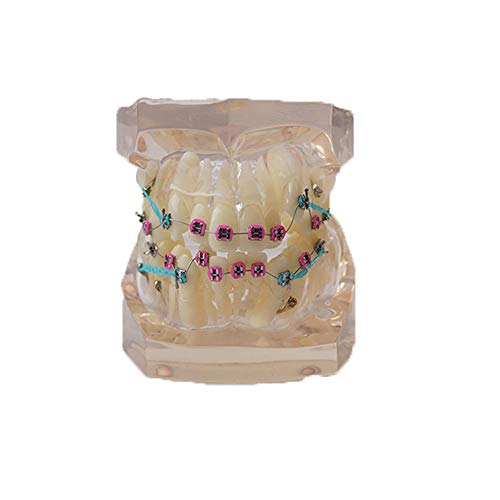 Metal Bracket Dental Model - Crowded Teeth, Mandibular Protrusion & Opening - Ideal for Dental Lab Research & Teaching - Perfect for Orthodontic Training & Patient Education