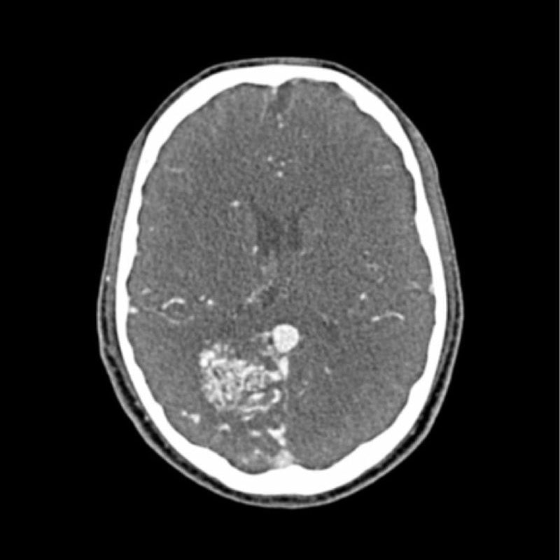 CTA AVM Head Phantom for CT Scan & X-Ray Training - Medical Imaging Practice, Radiology Education & Diagnostic Testing Simulation