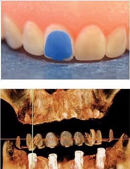 Scaneez DentureMark Cone Beam Markers - Universal Molar Markers for Dental Scans (110 Count/Box) | Perfect for CBCT Imaging, Dental Prosthetics & Oral Surgery Procedures