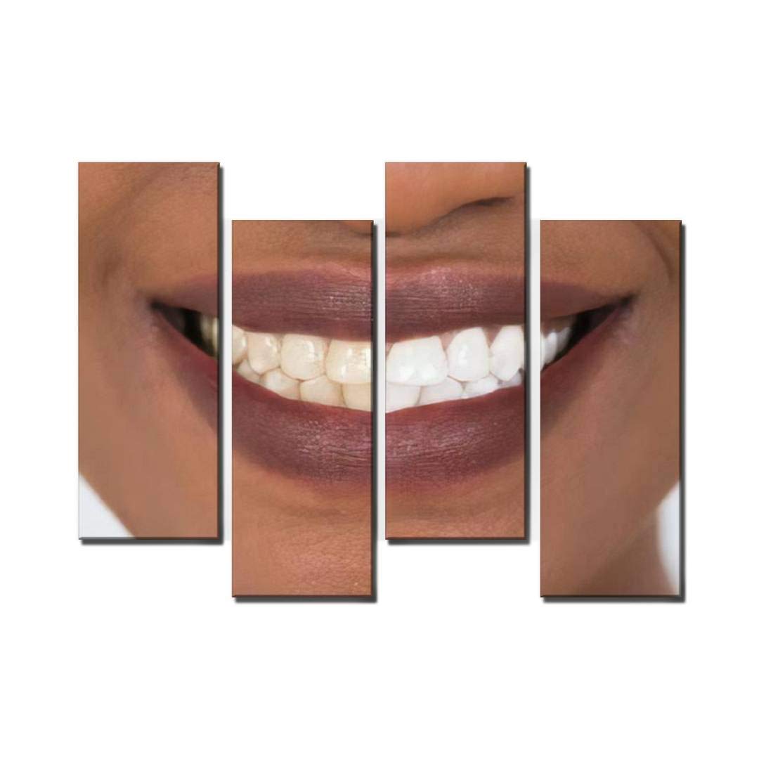 Smiling Woman Teeth Whitening Before and After Canvas Wall Art - Stretched & Framed Home Decor for Living Room, Bedroom, or Office