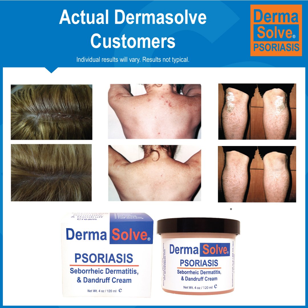Dermasolve Psoriasis Treatment Kit for Body & Scalp - Complete Relief for Dry, Itchy Skin & Scalp Care - Ideal for Daily Use at Home or Travel