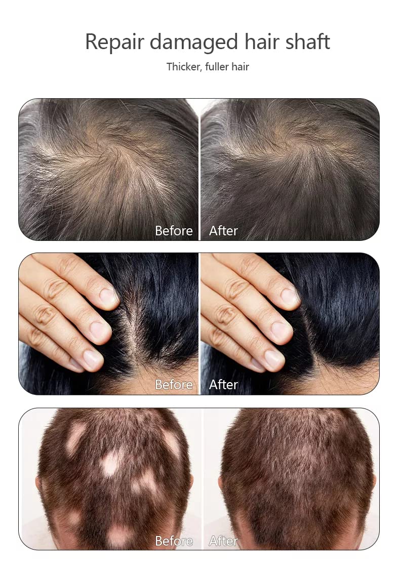 5 in 1 Multifunctional Hair Regrowth System for Men & Women - Anti Hair Loss Treatment with Laser Comb & Essential Oils - Stimulates Growth for Thinning Hair (Perfect for Home Use & Salon Treatments)
