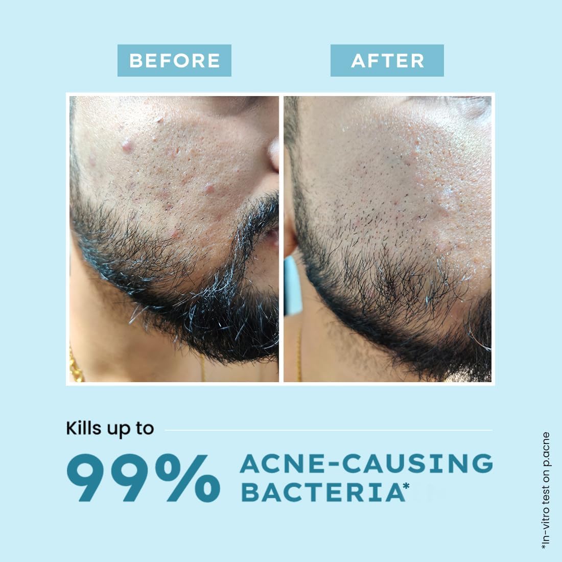 Hyphen Clarifying Acne Face Wash for Women & Men - 2% Salicylic Acid, Zinc PCA & 10% Witch Hazel Cleanser for Acne-Prone Skin - 100ml | Daily Deep Cleansing & Oil Control for Clear, Healthy Skin