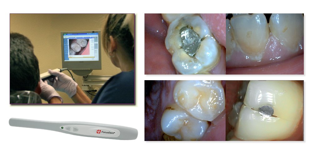 MD740 Dental Intraoral Camera with USB Connection - 6 LED Lights & 1.3MP HD Imaging - Includes Dental Software for Oral Examinations & Patient Education