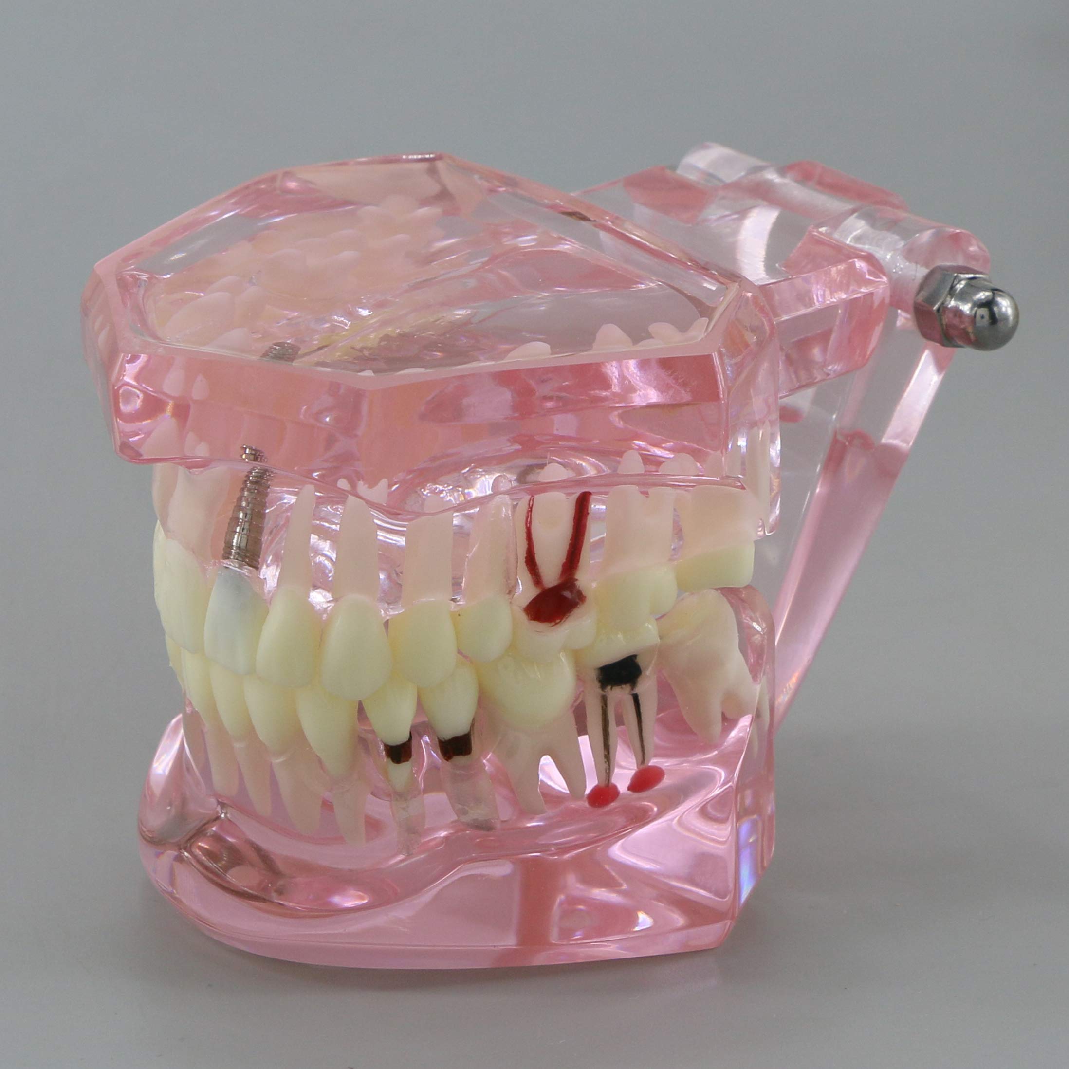 Dental Teeth Model - Implant Restoration Bridge Typodont for Dental Teaching & Study - Oral Pathology Demonstration (M2001 Pink) - Perfect for Dental Schools, Clinics & Training Labs