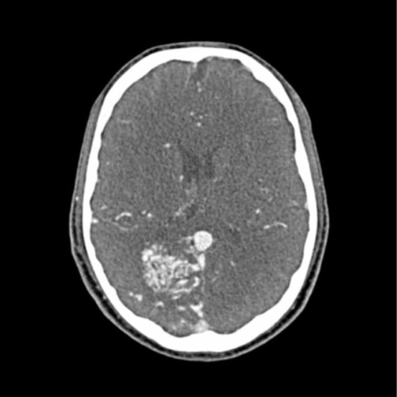 CTA AVM / Lesion Head Phantom - High-Quality CT Scan & X-Ray Training Tool for Medical Students & Radiology Professionals | Perfect for Diagnostic Imaging Practice & Medical Education