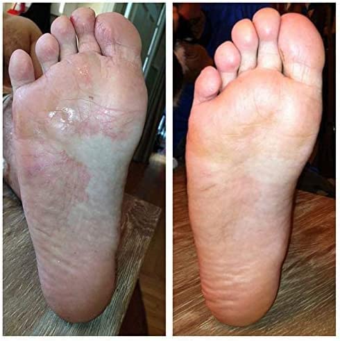 Best Fungal Nail Treatment & Athlete's Foot Cream Set - Fast-Acting Antifungal Solution for Toenail & Foot Care - Perfect for Gym, Pool & Home Use