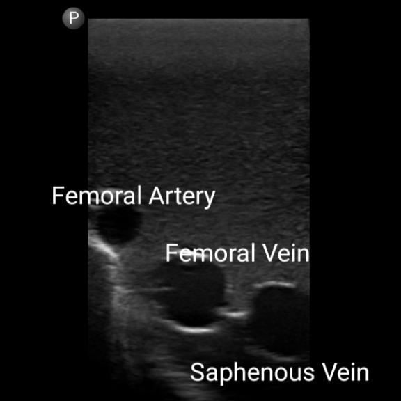 Gen II Femoral Vascular Access & Regional Anesthesia Ultrasound Training Model - Medical Simulation for Ultrasound-Guided Procedures Practice