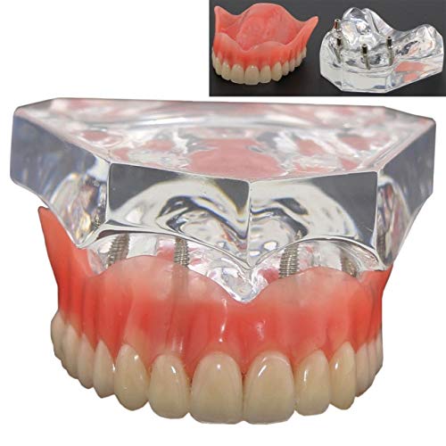Premium Dental Upper Teeth Model with 4 Implants - Over Denture Demo for Dentists & Students | Ideal for Dental Training, Education & Practice