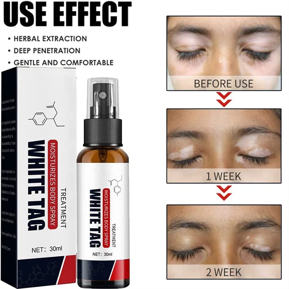 Dermax Psoriasis Treatment Spray for Scalp & Skin Relief – 30ml (2 Pack) – Fast-Acting Itch & Flake Solution for Dry, Irritated Skin – Perfect for Home, Travel & Daily Care